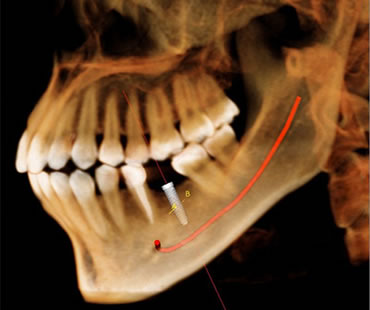 Dental implants Aventura