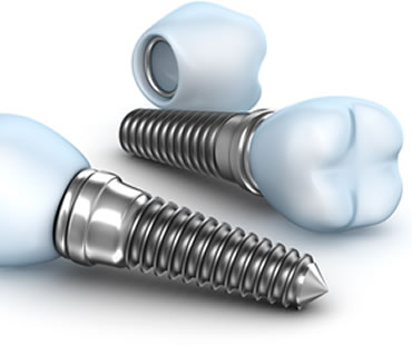 Implant dentist in Aventura