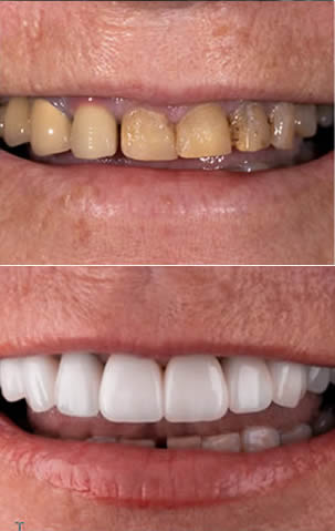 cosmetic dentistry before after aventura 1