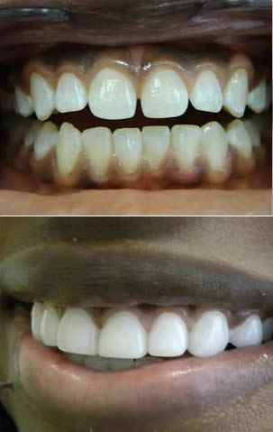cosmetic dentistry before after aventura 2