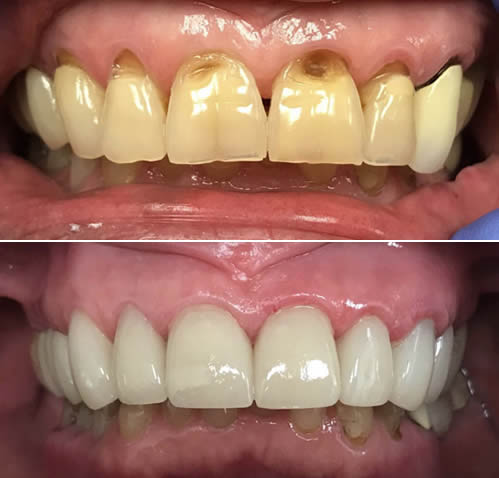 cosmetic dentistry before after aventura 4